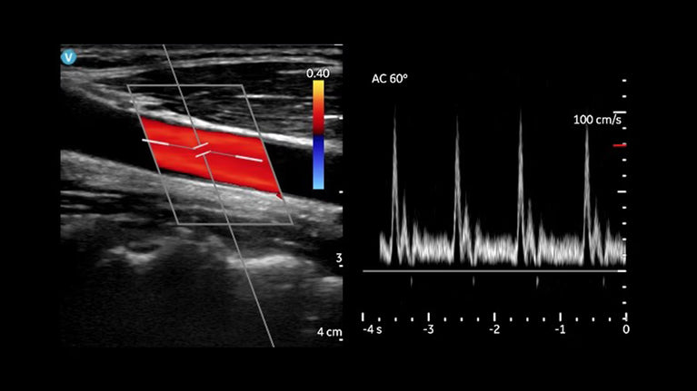 VSCAN AIR CL HANDHELD ULTRASOUND